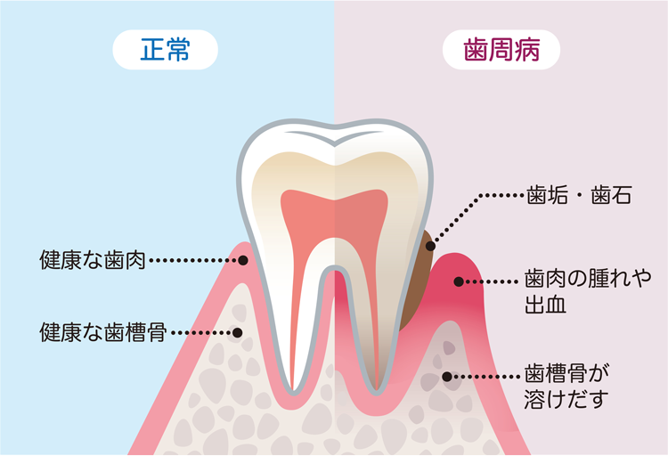 正常（健康な歯肉/健康な歯槽骨）　歯周病（歯垢・歯石/歯肉の腫れや出血/歯槽骨が溶けだす）